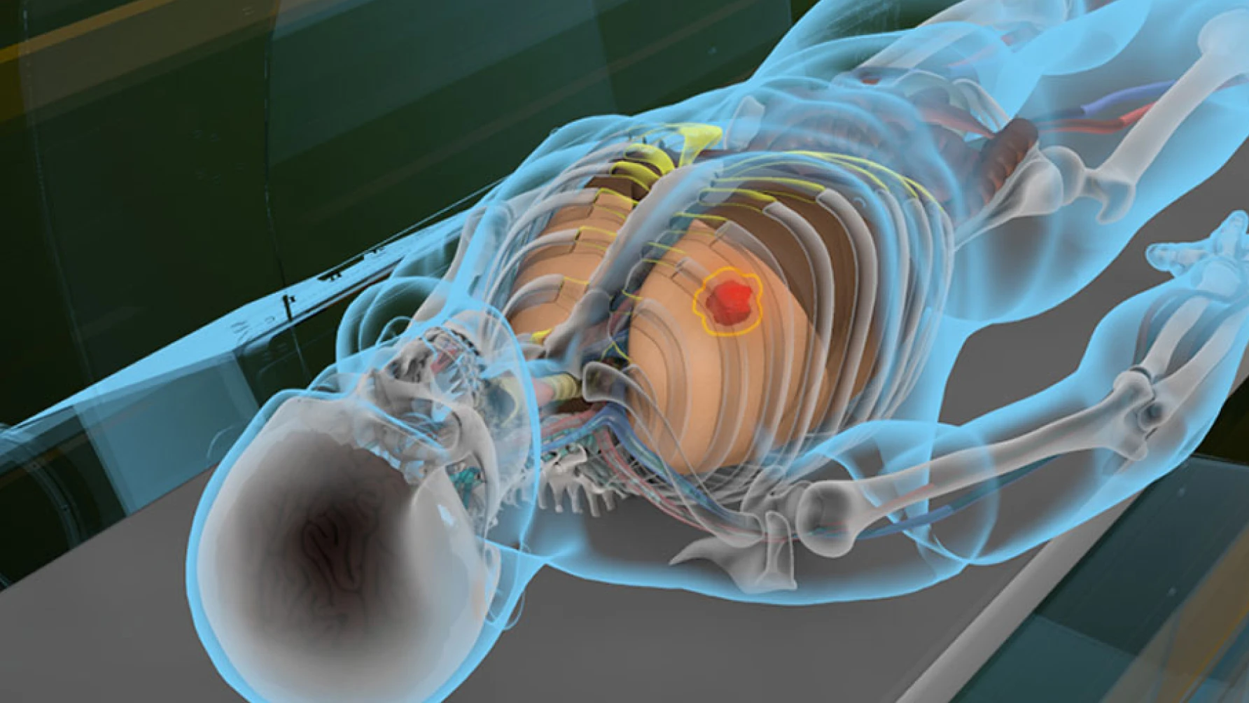 A 3D medical illustration showing a semi-transparent human body lying on a scanner table, with internal organs, skeletal system, and a highlighted red and yellow tumor in the left lung area.